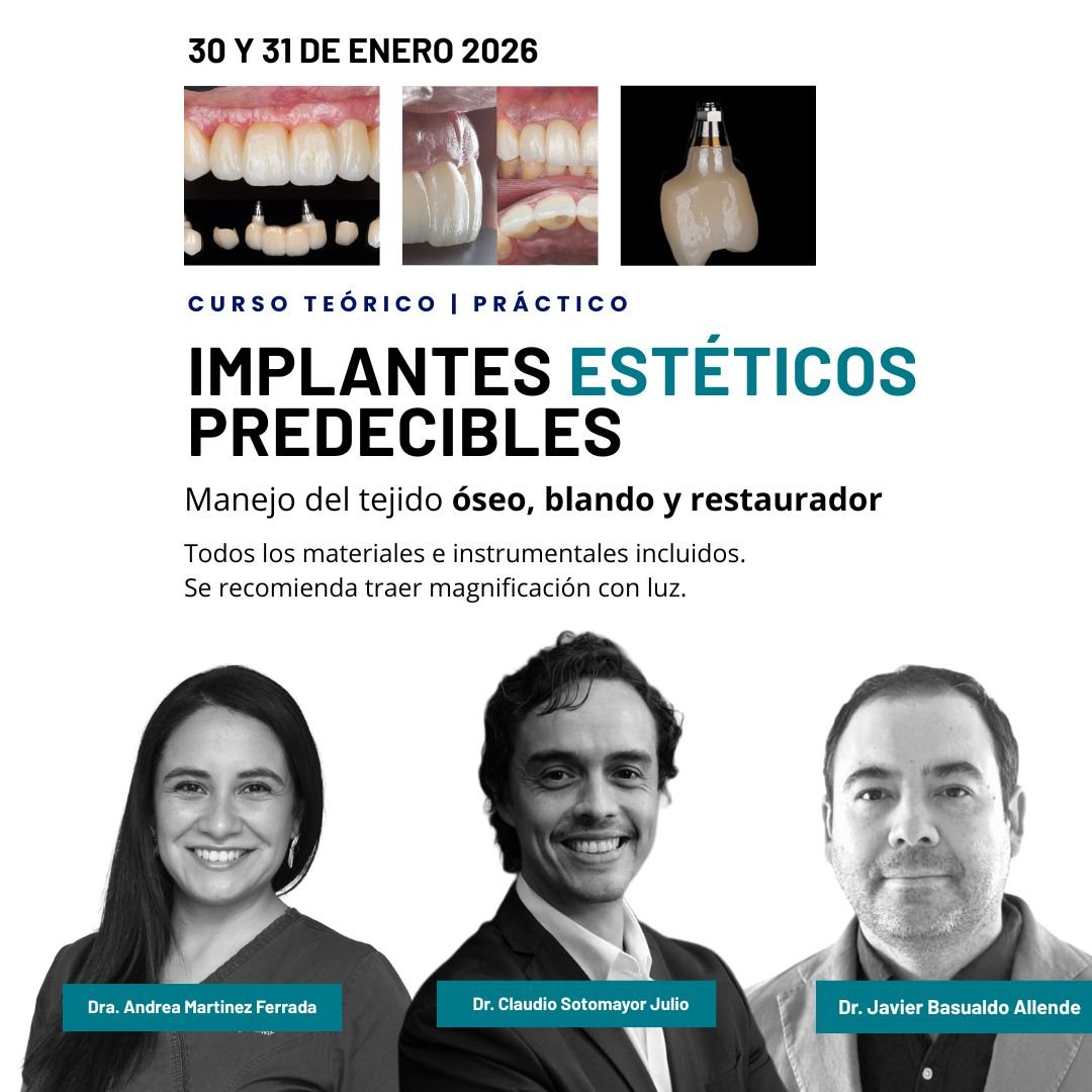 Implantes Estéticos Predecibles: Manejo del tejido óseo, blando y restaurador