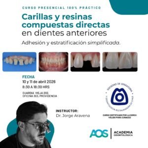Carillas y resinas compuestas directas en dientes anteriores: Adhesión y estratificación simplificada.