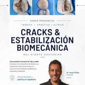 Curso presencial | Cracks & Estabilización Biomecánica del diente posterior