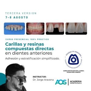 Carillas y resinas compuestas directas en dientes anteriores: Adhesión y estratificación simplificada. 3era versión